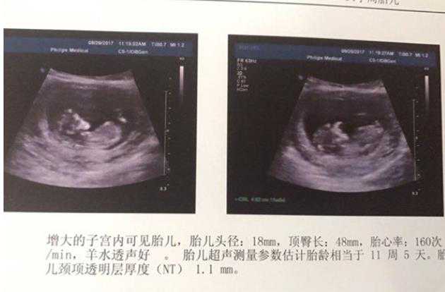 广州les生子 广州试管婴儿成功率医院排名好医院参考 ‘孕囊68*68*32是男是女’